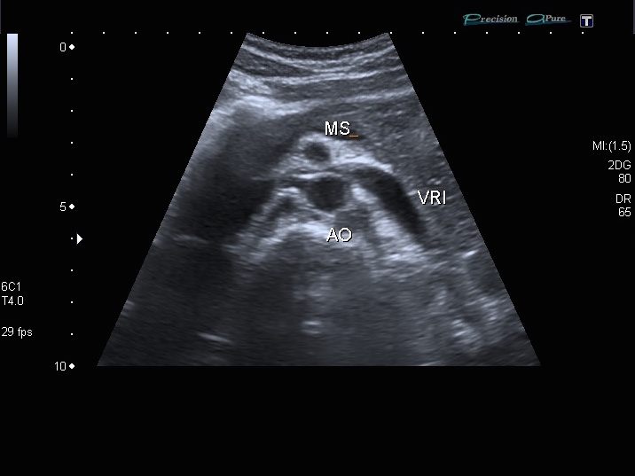 Nutcracker syndrome Image