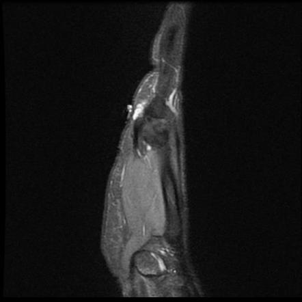 Ganglion cyst - flexor tendon sheath / A1 pulley | Image | Radiopaedia.org