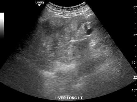 Steatohepatitis - masslike steatosis | Radiology Case | Radiopaedia.org