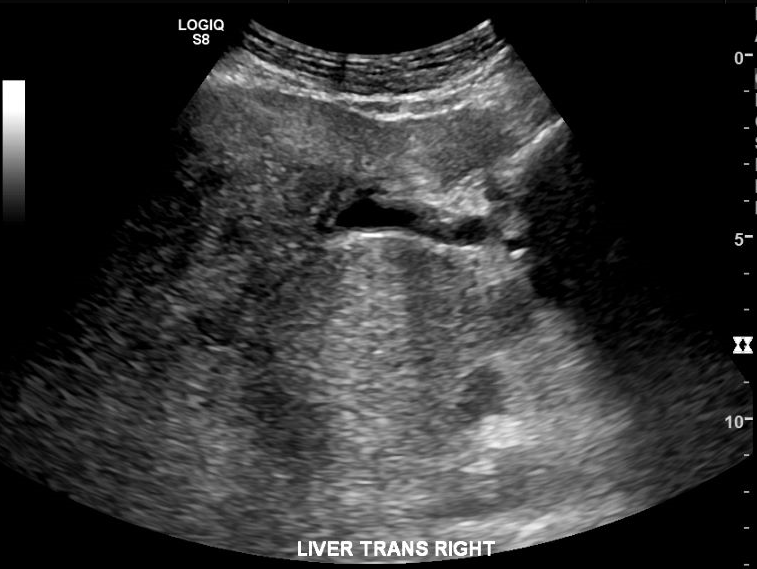 Steatohepatitis - masslike steatosis | Image | Radiopaedia.org