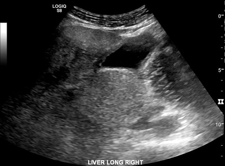 Steatohepatitis - masslike steatosis | Image | Radiopaedia.org