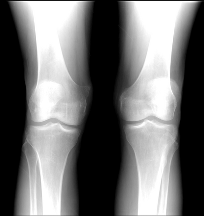 Osteochondroma | Radiology Reference Article | Radiopaedia.org