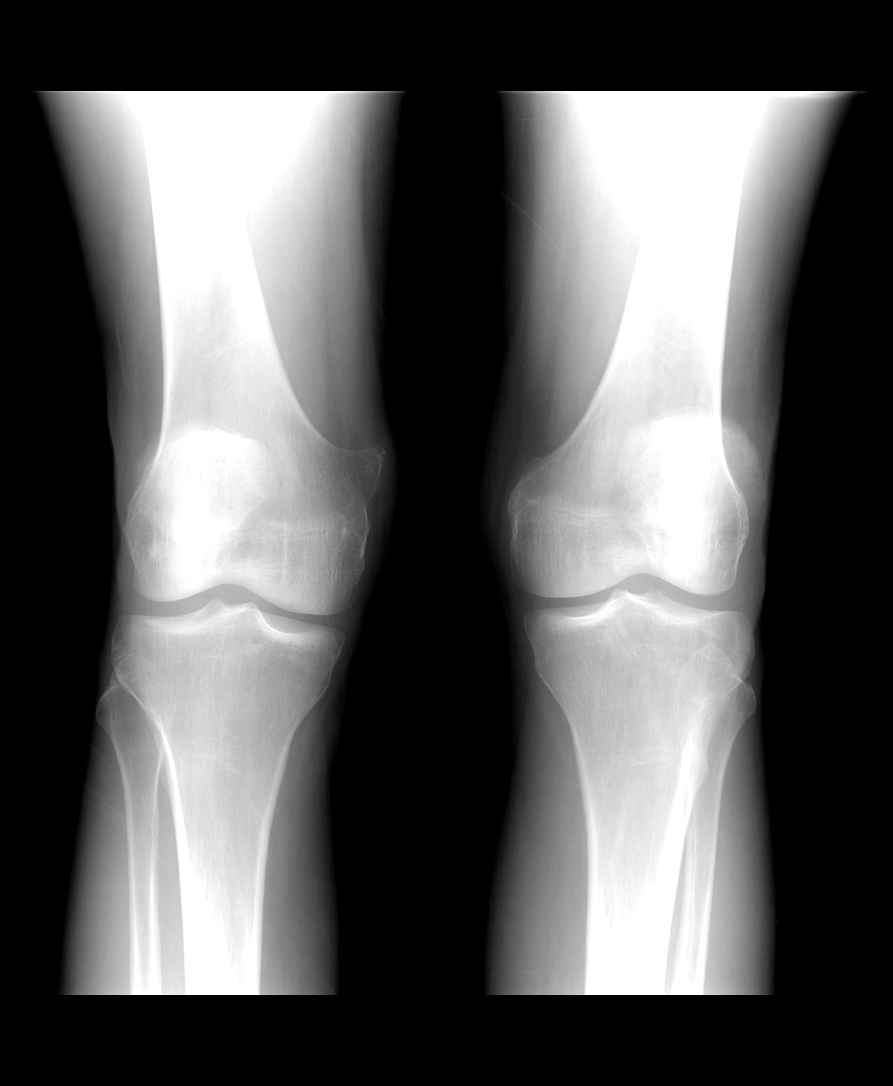 Osteochondroma | Image | Radiopaedia.org