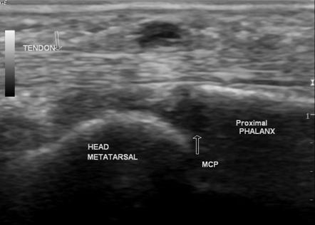 Peripully ganglion cyst | Radiology Case | Radiopaedia.org