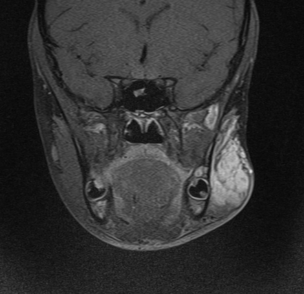 Infantile hemangioma | Image | Radiopaedia.org