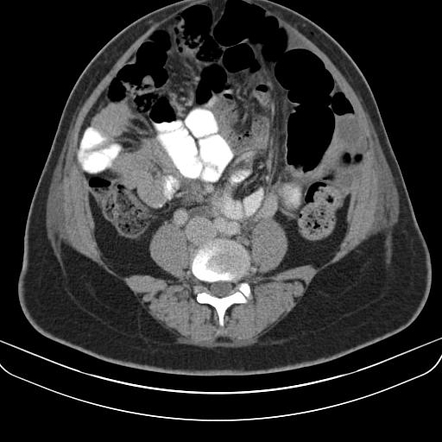 Surgical hemostatic material | Radiology Case | Radiopaedia.org