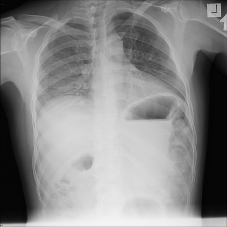 Pneumoperitoneum | Radiology Case | Radiopaedia.org