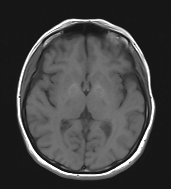 Eye Of The Tiger Sign Radiology Case Radiopaedia Org