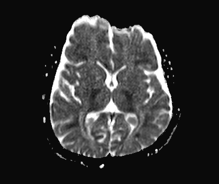 Eye Of The Tiger Sign Image Radiopaedia Org