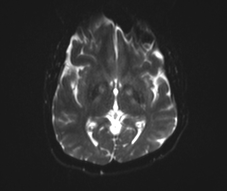 Eye Of The Tiger Sign Image Radiopaedia Org