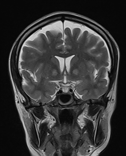 Eye Of The Tiger Sign Image Radiopaedia Org