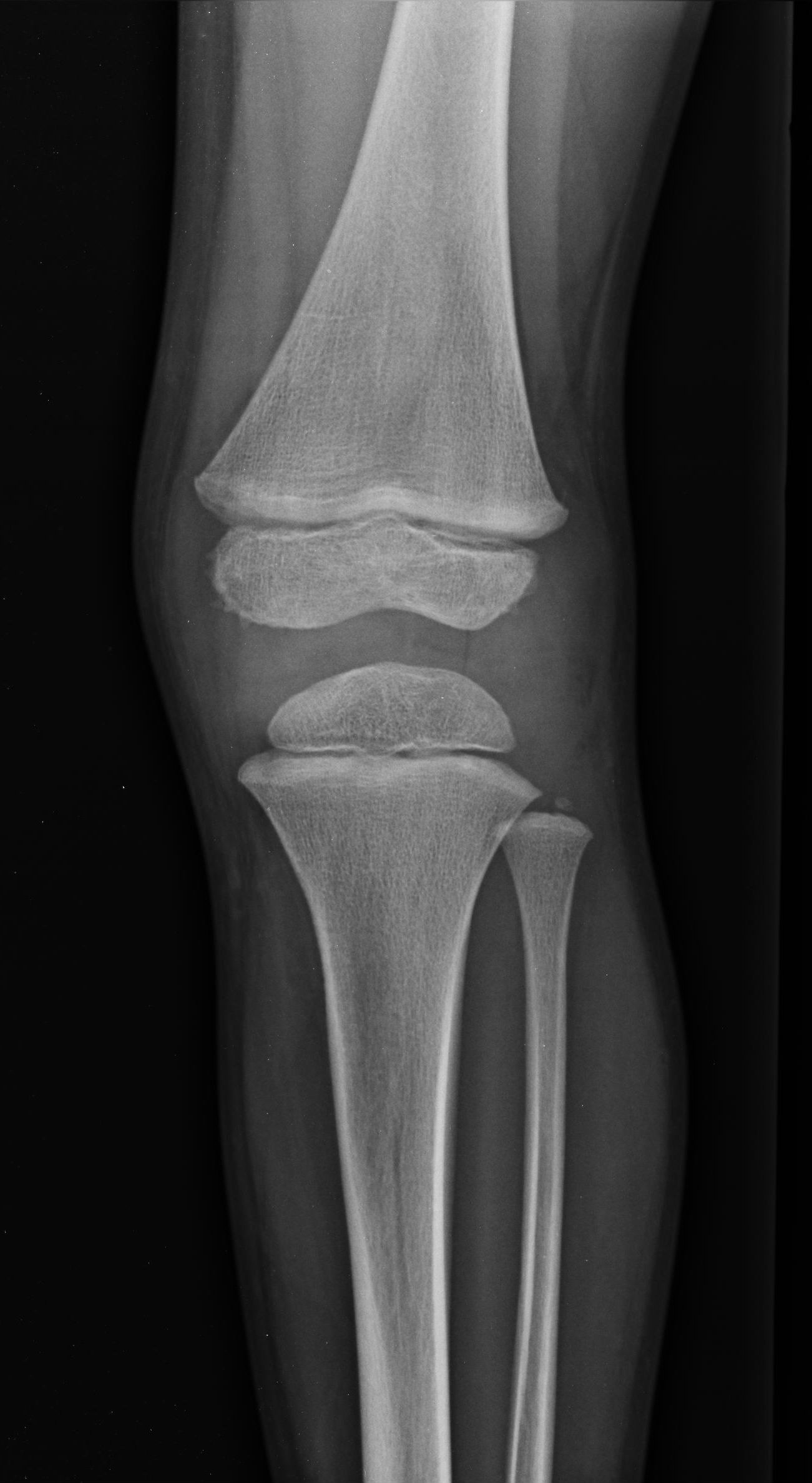 Popliteal cyst in child | Image | Radiopaedia.org