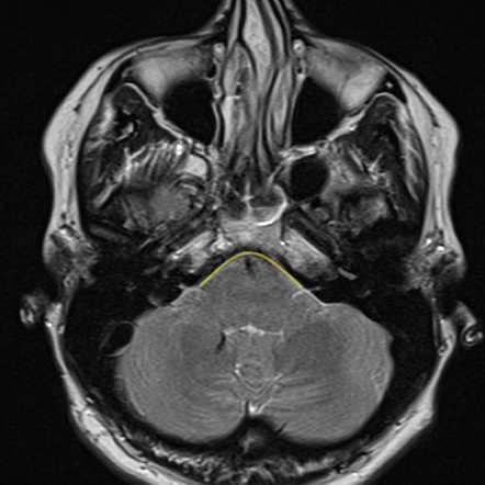 Intracranial hypotension | Image | Radiopaedia.org