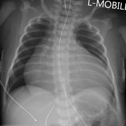 Ebstein anomaly | Radiology Reference Article | Radiopaedia.org