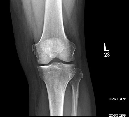 Pellegrini-Stieda lesion | Radiology Reference Article | Radiopaedia.org