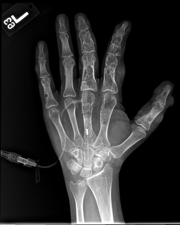 Enchondromatosis | Radiology Reference Article | Radiopaedia.org