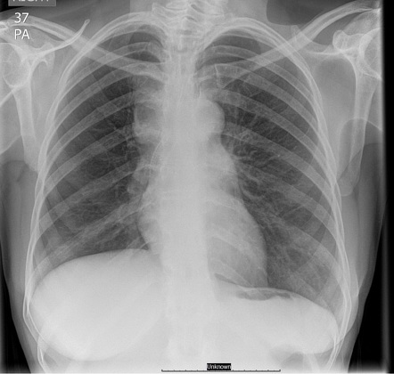 Tracheobronchial stent | Radiology Reference Article | Radiopaedia.org