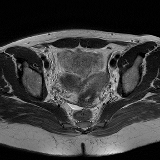 Müllerian duct anomaly - type IIb | Image | Radiopaedia.org