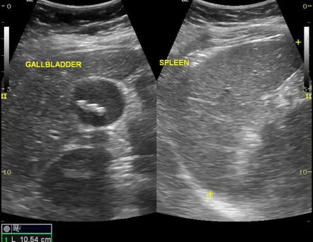 Acute Cholecystitis Ultrasound