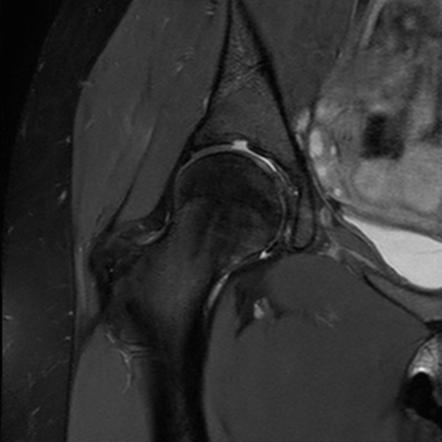 Supra-acetabular fossa | Image | Radiopaedia.org