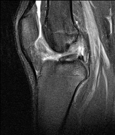 O'Donoghue unhappy triad | Radiology Reference Article | Radiopaedia.org