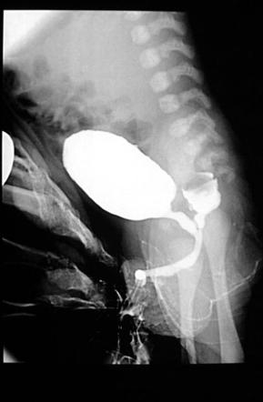 Anal atresia - Radiology Reference Article - Radiopaedia.org