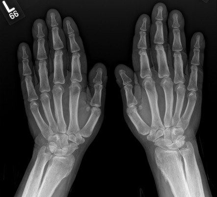 Pachydermoperiostosis | Radiology Case | Radiopaedia.org