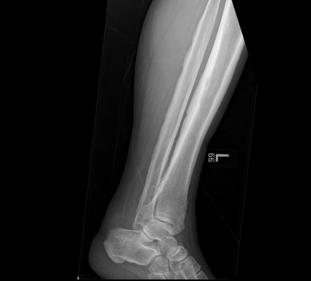 Pachydermoperiostosis | Radiology Reference Article | Radiopaedia.org