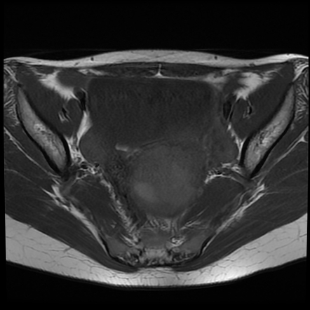 Myxoid uterine leiomyoma | Radiology Case | Radiopaedia.org