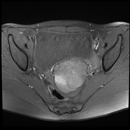 Myxoid uterine leiomyoma | Image | Radiopaedia.org