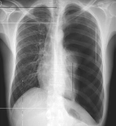 pneumothorax case study scribd