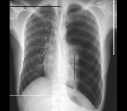 Spontaneous pneumothorax | Radiology Case | Radiopaedia.org