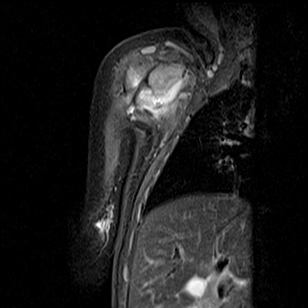 Caffey disease | Image | Radiopaedia.org