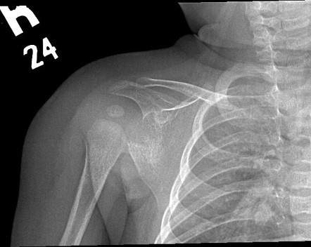 Caffey disease | Image | Radiopaedia.org