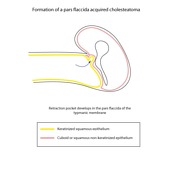 Tympanic membrane retraction | Radiology Reference Article ...