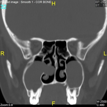 Antrochoanal polyp | Radiology Case | Radiopaedia.org