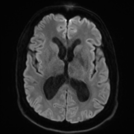 Achondroplasia | Image | Radiopaedia.org