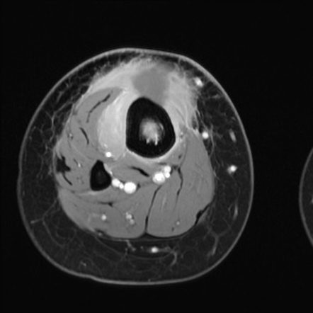 Primary bone lymphoma | Radiology Case | Radiopaedia.org