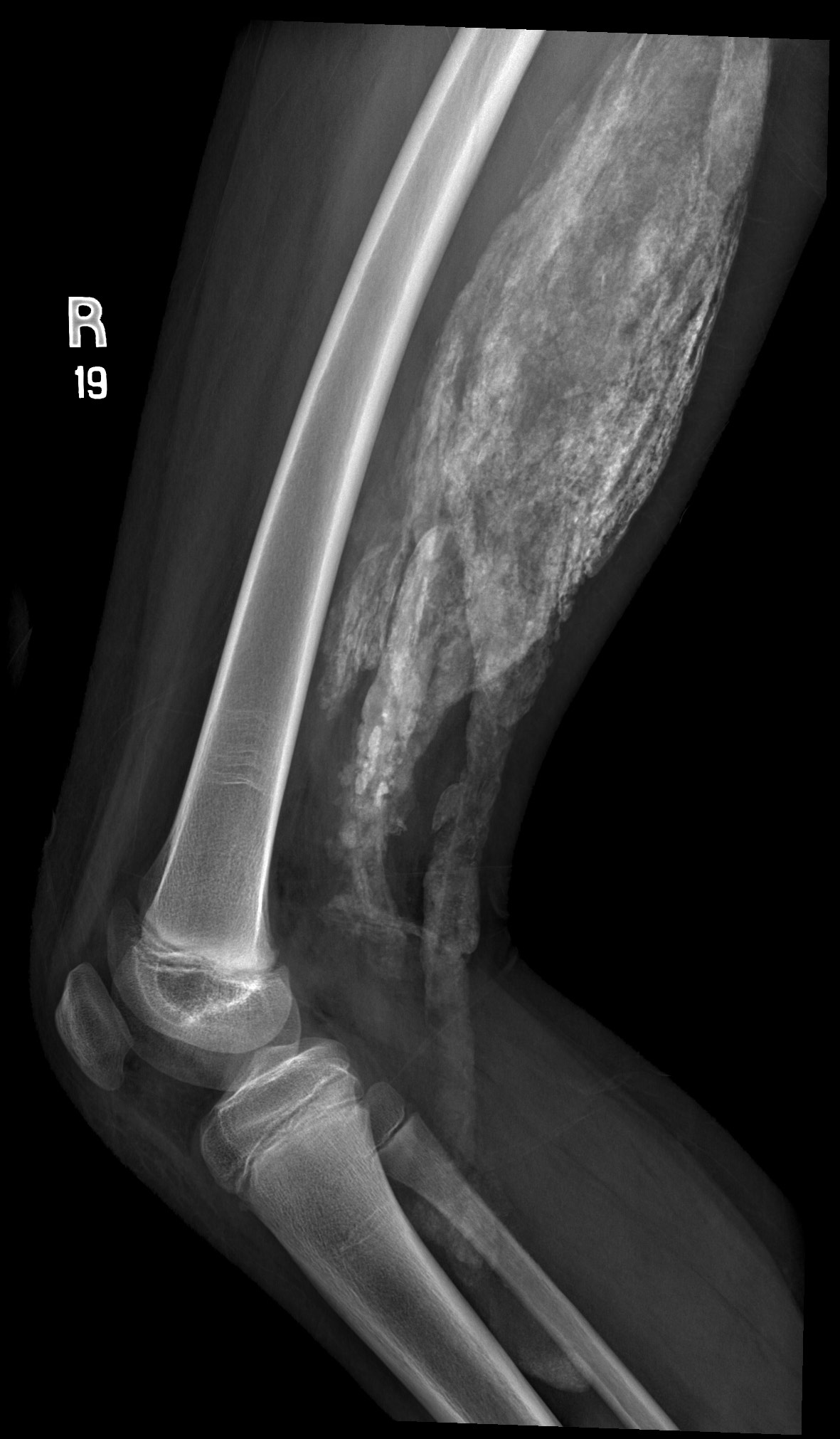 Dermatomyositis | Image | Radiopaedia.org