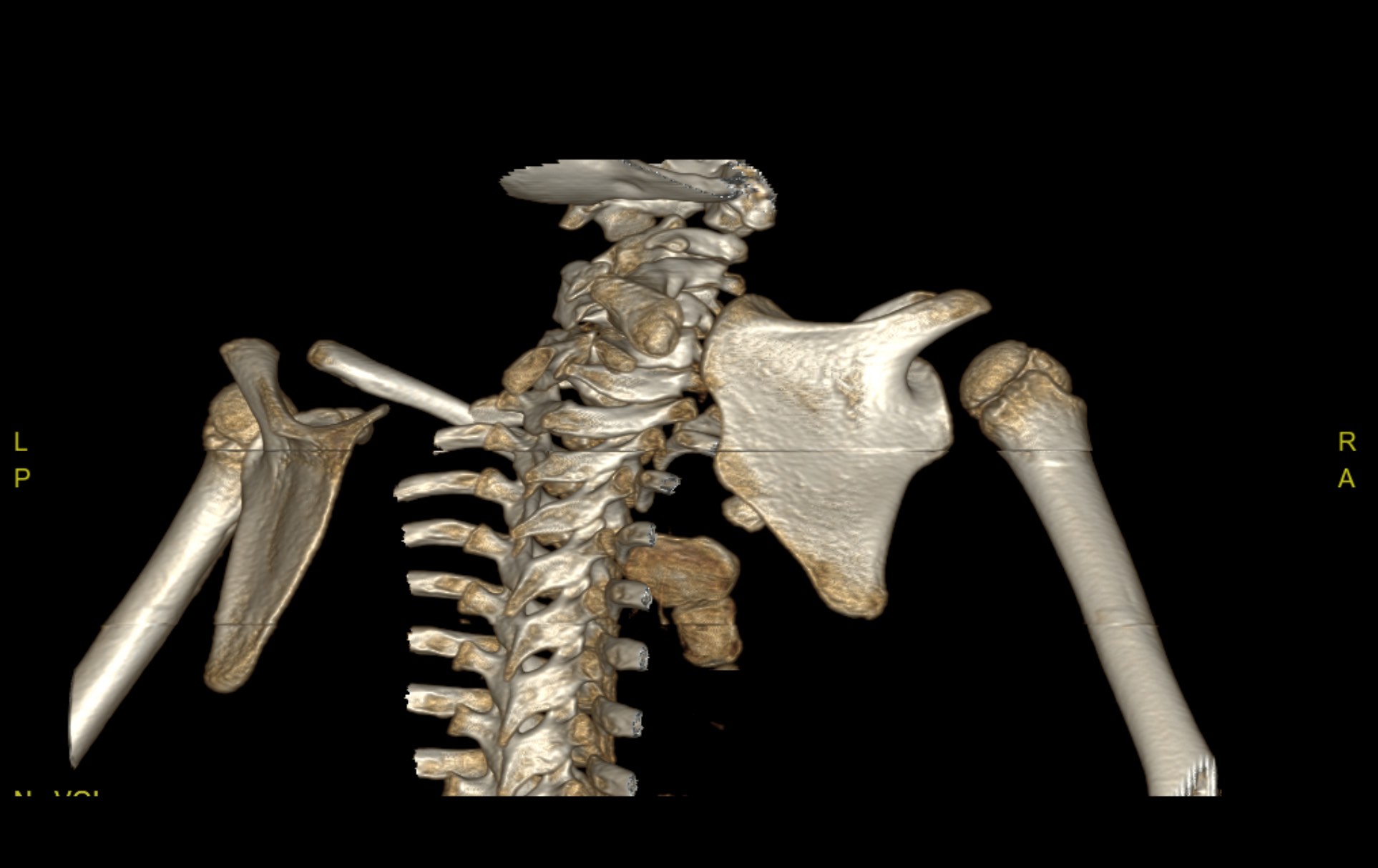 Klippel Feil Syndrome - Sprengel Deformity | Image | Radiopaedia.org