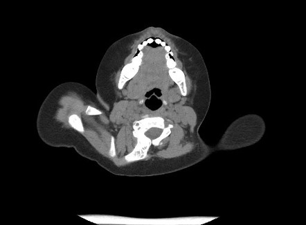 Klippel Feil Syndrome - Sprengel Deformity | Image | Radiopaedia.org