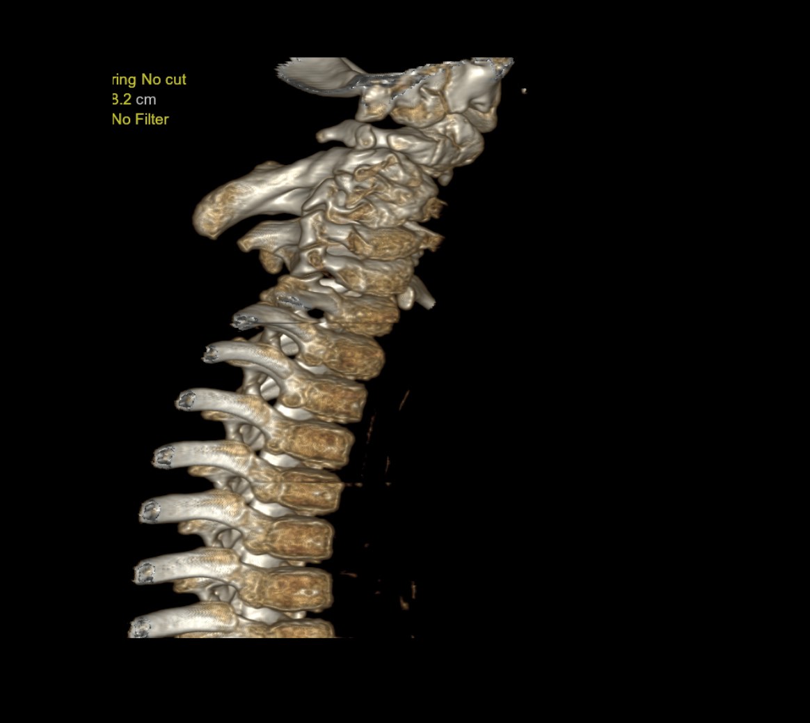 Klippel Feil Syndrome - Sprengel Deformity | Image | Radiopaedia.org