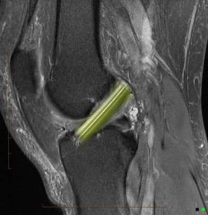 Anterior cruciate ligament mucoid degeneration | Radiology Reference ...