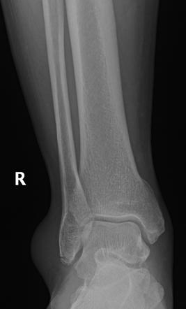 Weber classification of ankle fractures | Radiology Reference Article ...