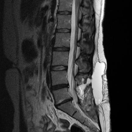 Congenital spinal meningocele | Radiology Reference Article ...