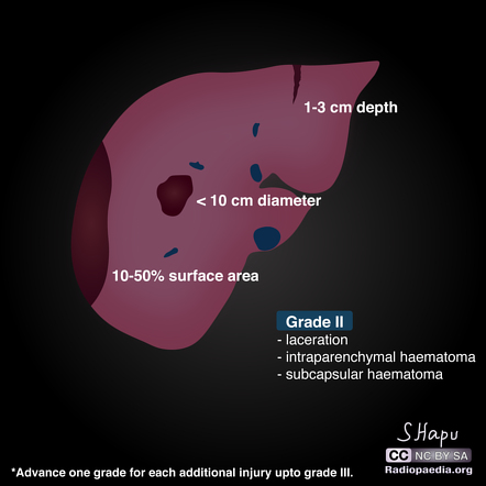 Liver trauma grading (diagrams) | Image | Radiopaedia.org