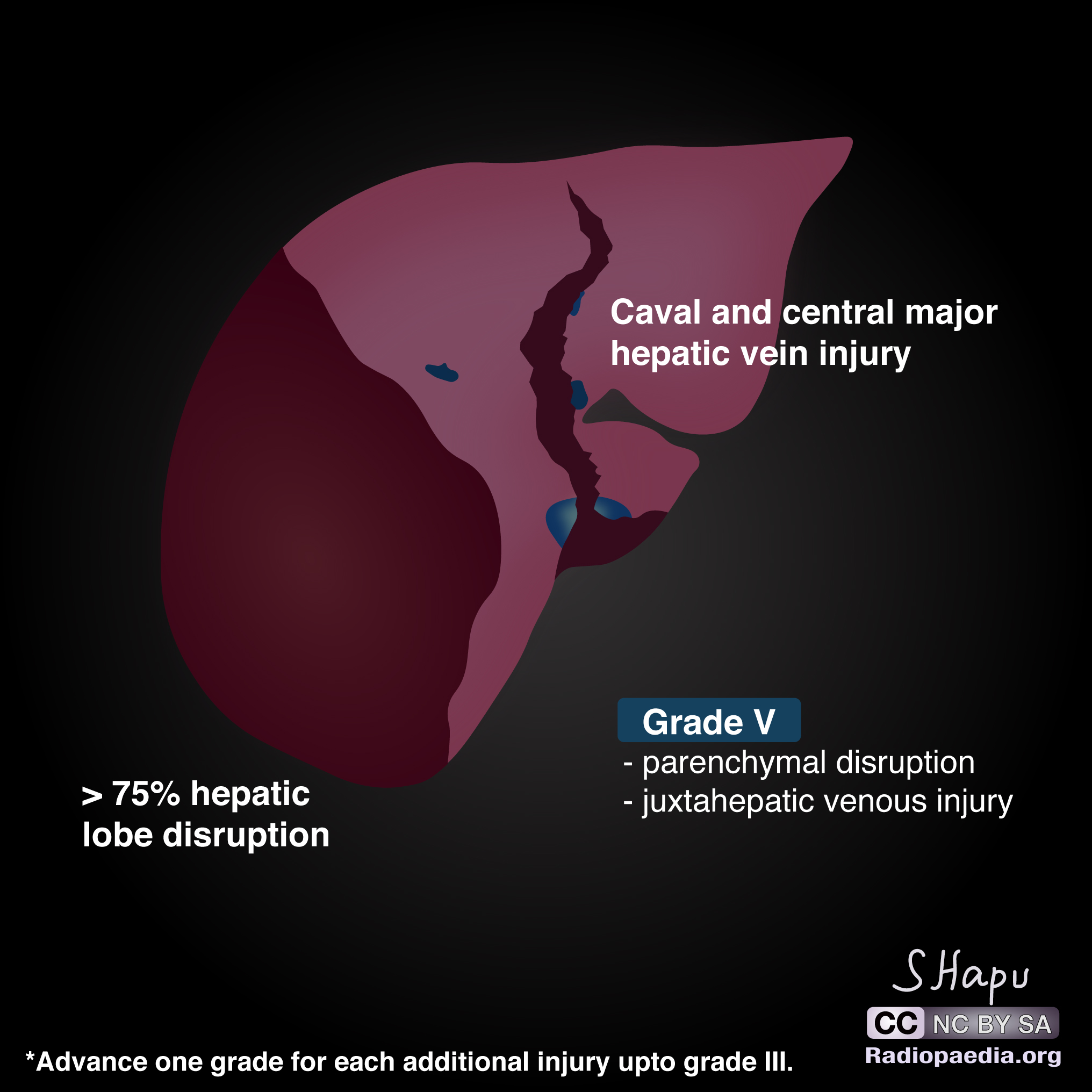 Liver trauma grading (diagrams) | Image | Radiopaedia.org