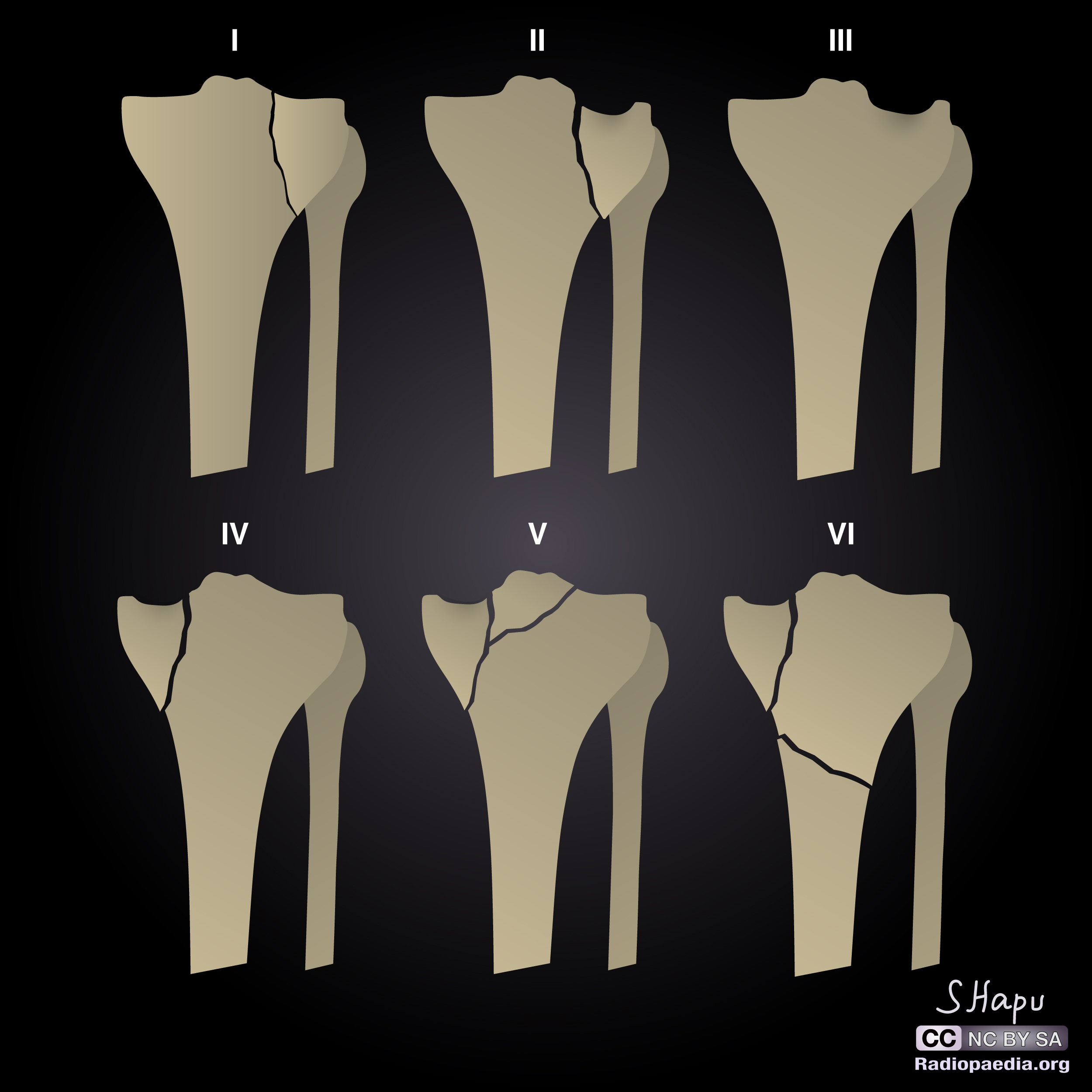 Schatzker Classification Diagram Image