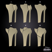 Schatzker classification of tibial plateau fractures | Radiology ...