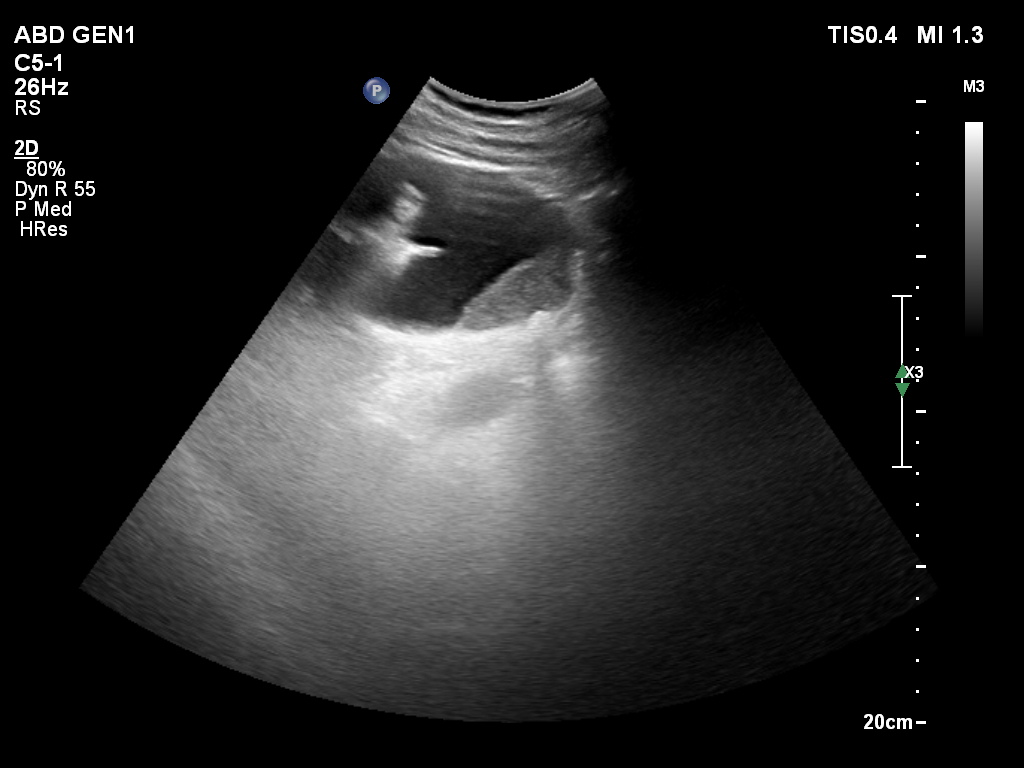 Pyonephrosis | Image | Radiopaedia.org